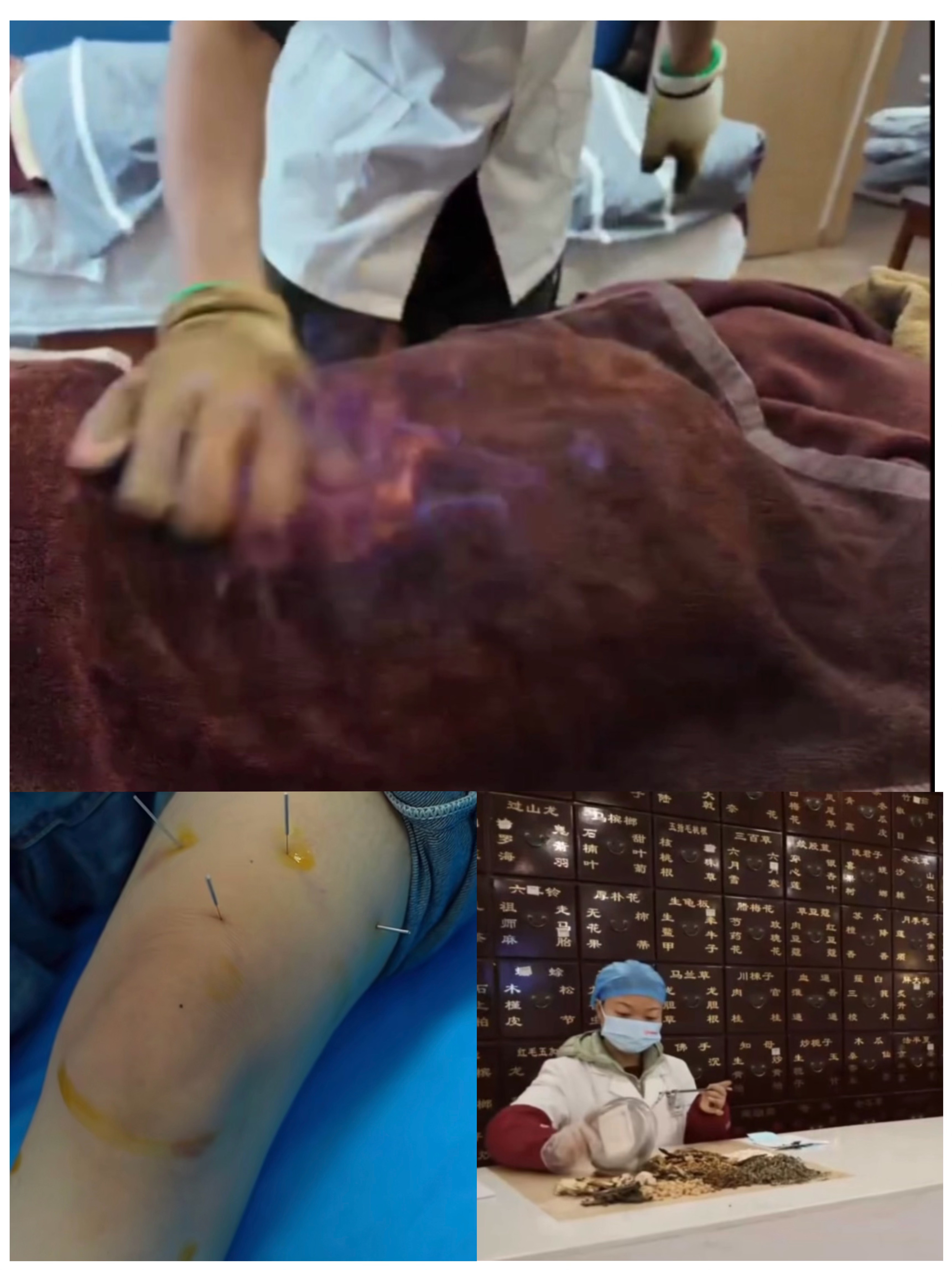 TCM fire therapy and acupuncture for knee pain in Chengdu