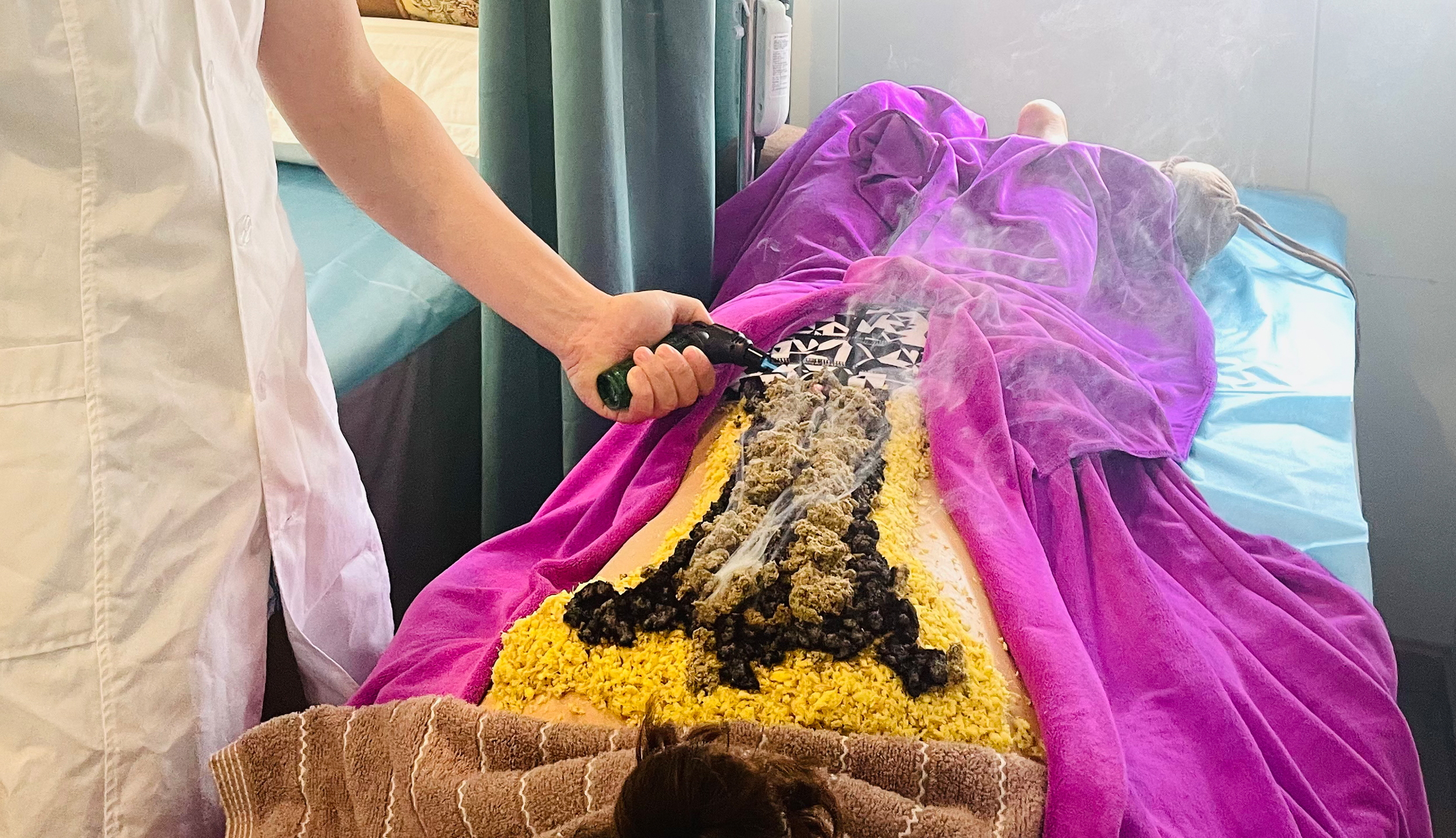 火龙灸 | Fire Dragon Moxibustion