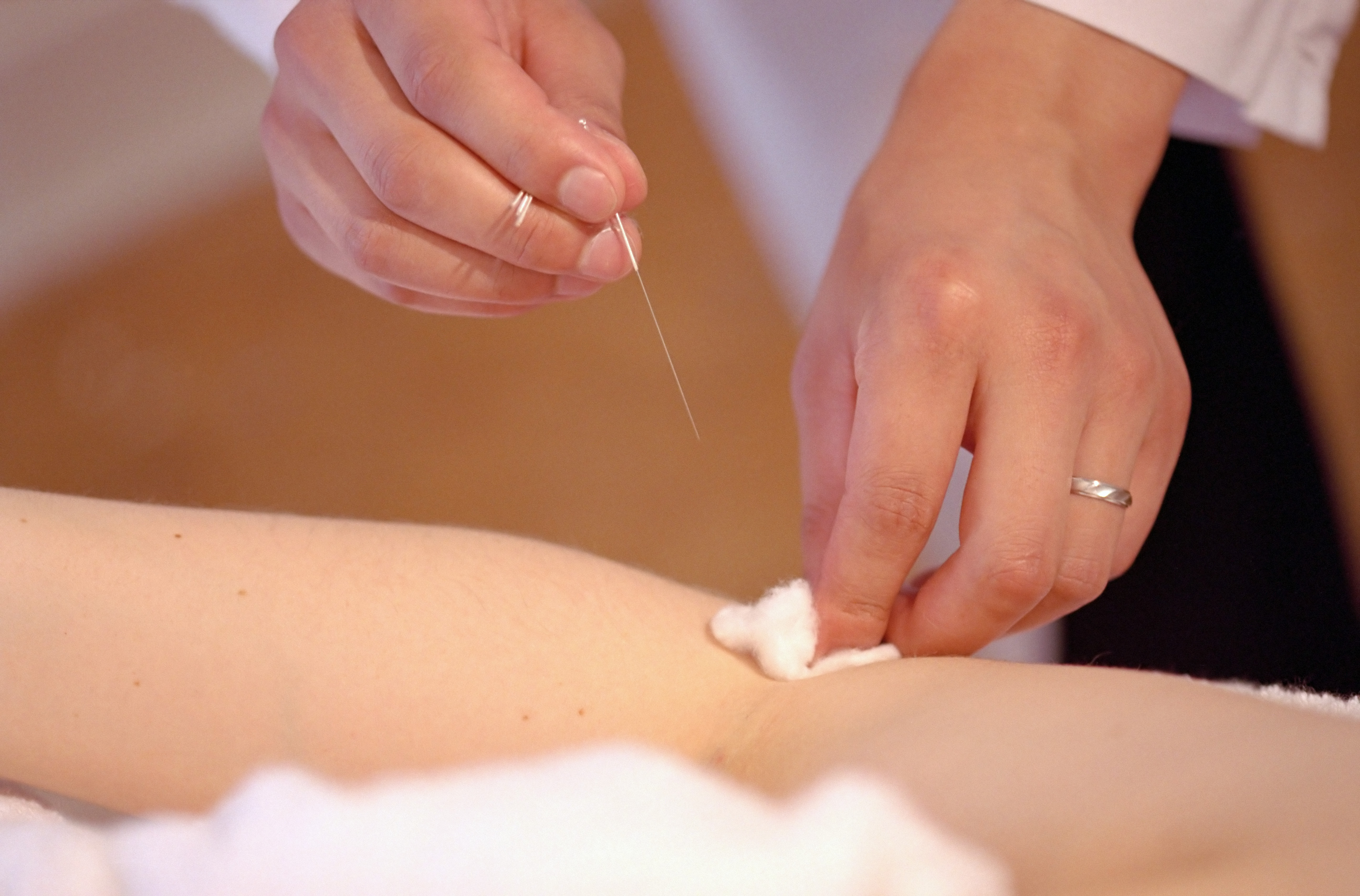 针灸 | Acupuncture